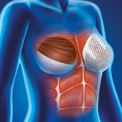 Cellis Breast Mesh