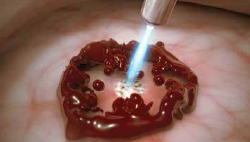 PlasmaJet Koagulation