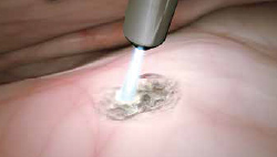 PlasmaJet Verdampfung